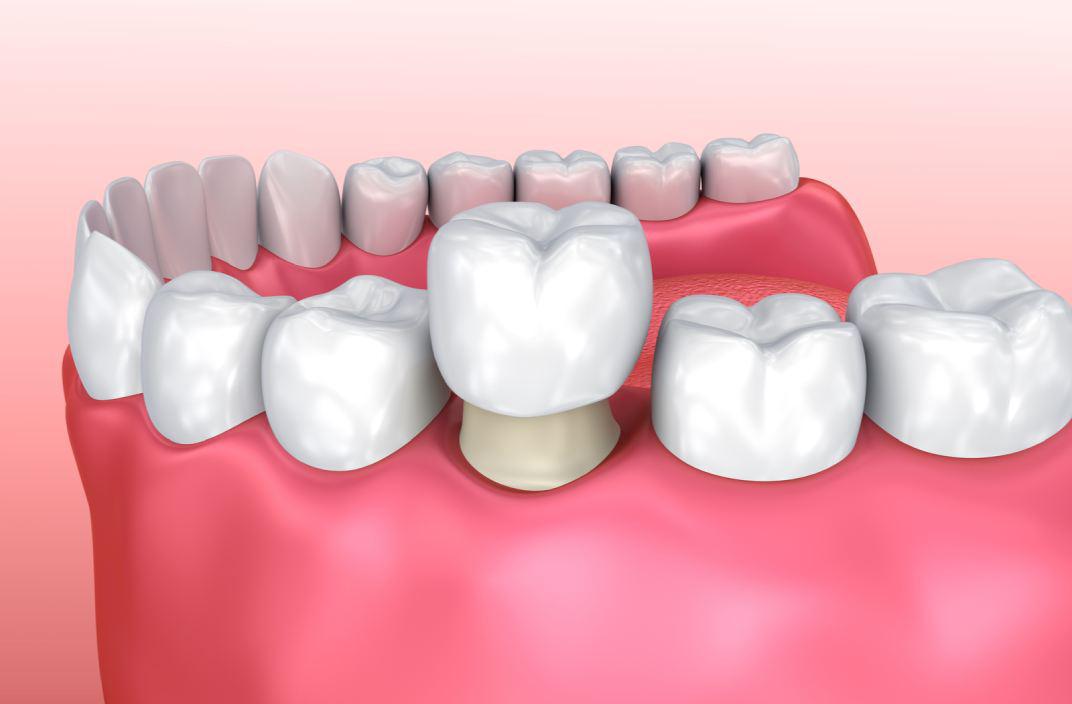 Tandheelkundige fez: voordele en nadele en hoe om dit te installeer | Jou mediese behandeling
