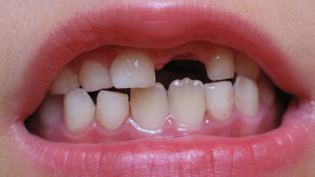 تكسر الأسنان في المنام