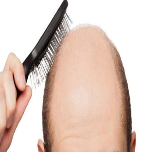 Baldness f'ħolma