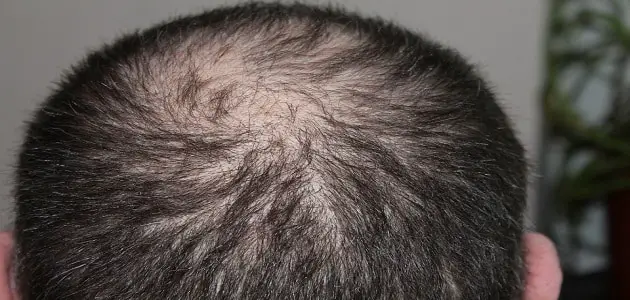 Munculé kesenjangan rambut ing ngimpi wanita ngandhut 1 - Interpretasi impen online