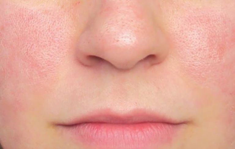 176 201358 causes enlarged pores treatment 2 - تفسير الاحلام اون لاين