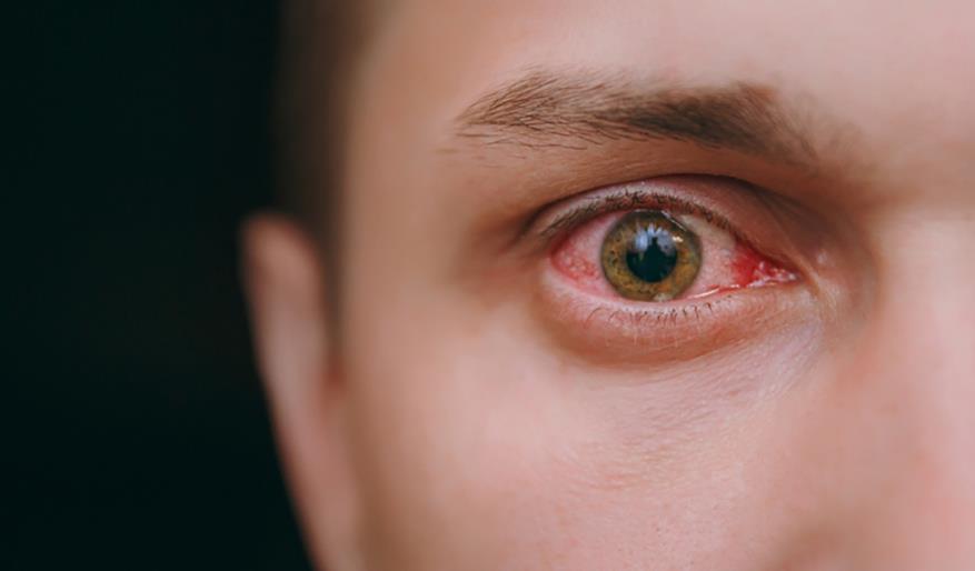 7 razones por las que tus ojos pueden estar rojos Lg - Interpretación de los sueños online