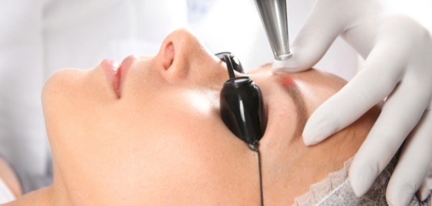 Algú ha provat el blanqueig de celles amb làser?