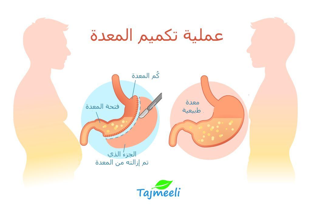 علاج التسريب بعد التكميم