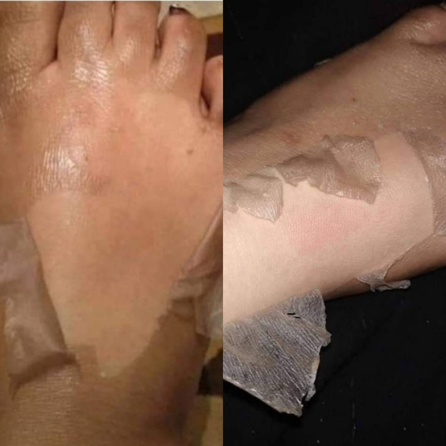 تجربتي مع تقشير احماض الفواكه