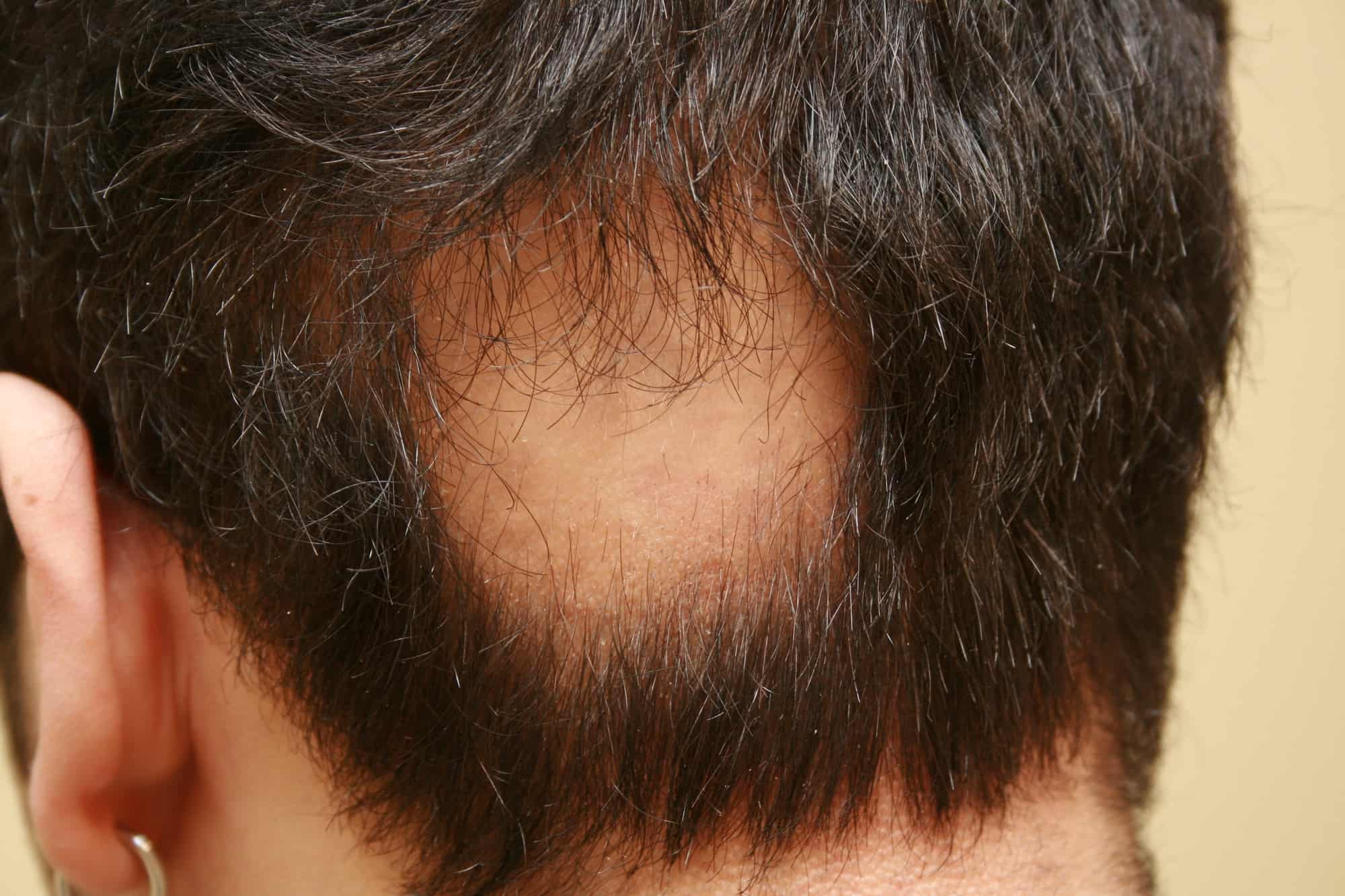 علاج الثعلبة بثلاث أيام