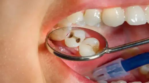 इब्न सिरिन के अनुसार एक अकेली महिला के लिए दांतों की सड़न के बारे में सपने की व्याख्या