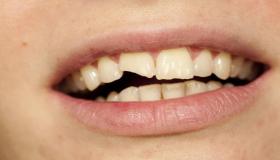 इब्न सिरिन के अनुसार टूटे हुए दांत के सपने की व्याख्या के लिए सबसे महत्वपूर्ण निहितार्थ