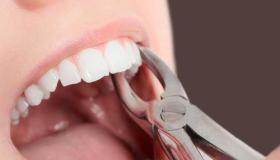 Ո՞րն է Իբն Սիրինի երազում ատամի արդյունահանման մեկնաբանությունը: