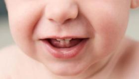 ما تفسير سقوط الاسنان في المنام لابن سيرين؟