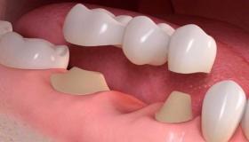 تفسير حلم تركيب تقويم الأسنان في المنام لابن سيرين