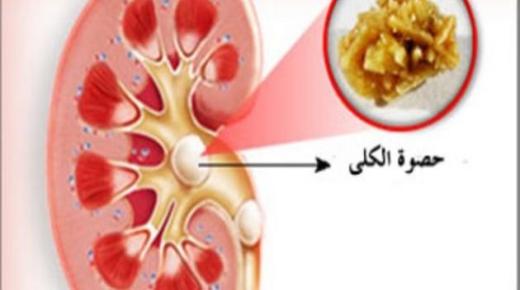 اعراض الرمل في الكلى