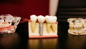 इब्न सिरिन के दांत निकालने के सपने की व्याख्या क्या है?